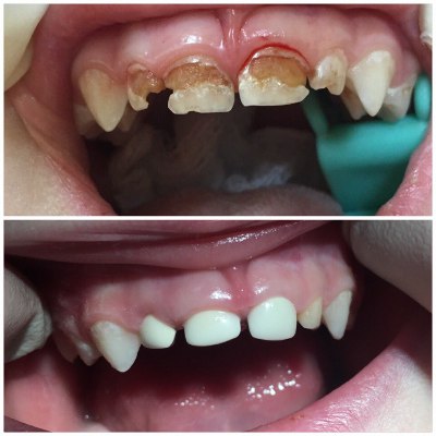 Современные методы обезболивания при лечении и удалении зубов детям